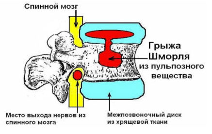 грыжа